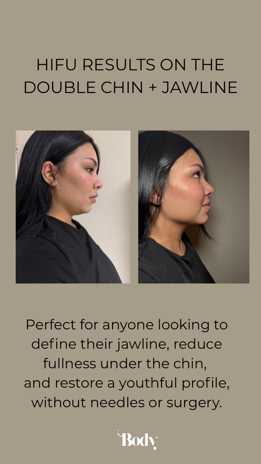 Sculpt Hifu jawline, double chin